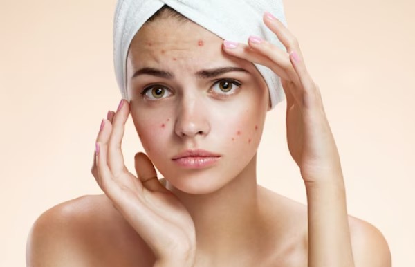 Pimple skin
