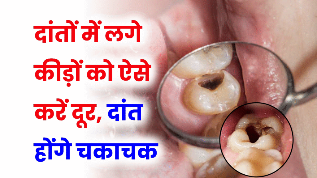 दांतों में लगे कीड़ों से परेशान? इन 4 घरेलू उपायों से मिलेगा तुरंत छुटकारा, डॉक्टर भी देते हैं सलाह
