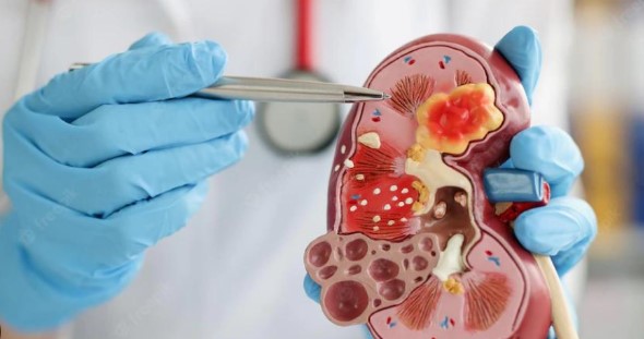 Kidney Failure