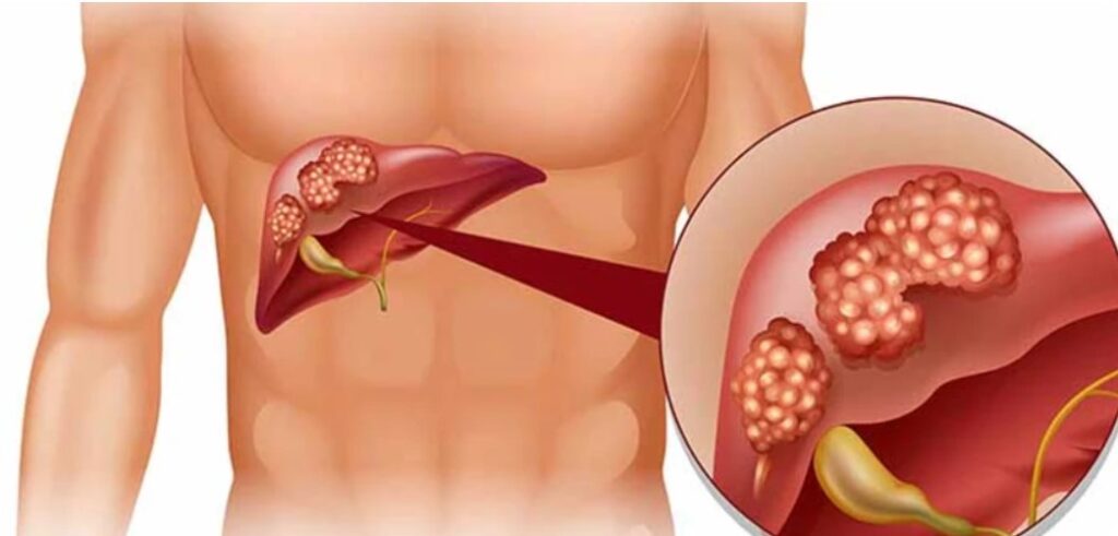 Liver Problems