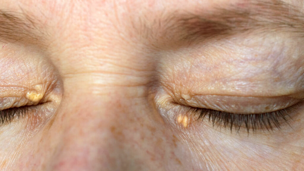 Xanthelasma