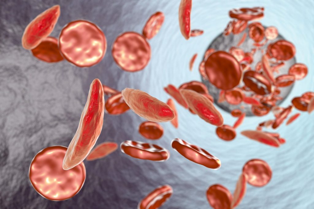 anemia