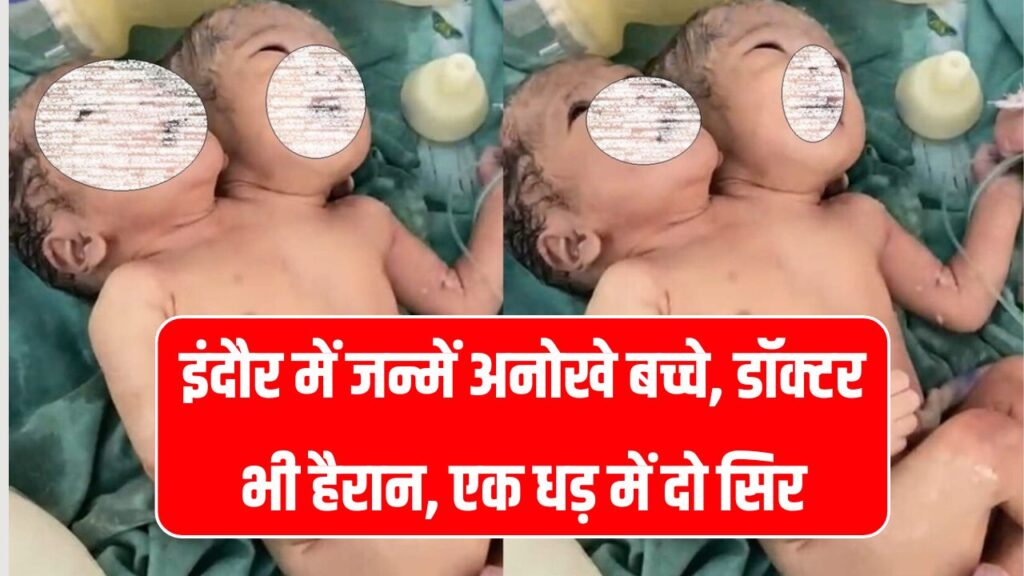 इंदौर में जन्में अनोखे बच्चे, डॉक्टर भी हैरान, एक धड़ में दो सिर, दो लिवर और दो फेफड़े