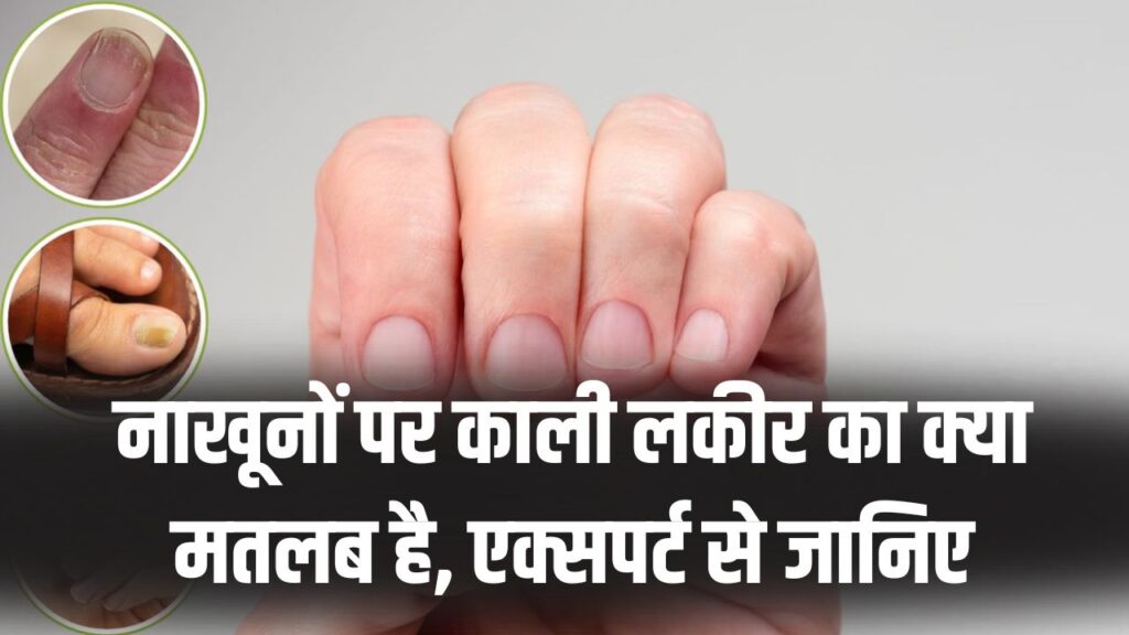 सावधान! नाखूनों पर काली लकीर दिखना सामान्य नहीं, एक्सपर्ट्स ने बताया ये किस गंभीर बीमारी का है संकेत।