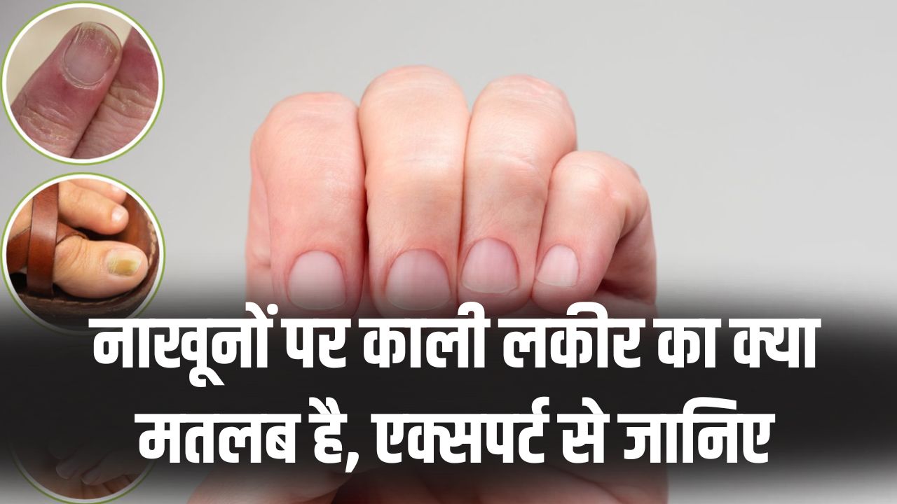 सावधान! नाखूनों पर काली लकीर दिखना सामान्य नहीं, एक्सपर्ट्स ने बताया ये किस गंभीर बीमारी का है संकेत।